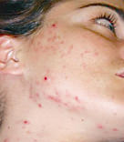 Acne Treatments Danville