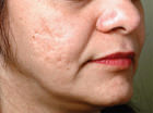 Acne Treatments Danville