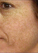 Laser Skin Resurfacing | Microdermabrasion | Chemical Peels | Danville