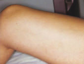 Sclerotherapy Danville