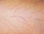 Sclerotherapy Danville