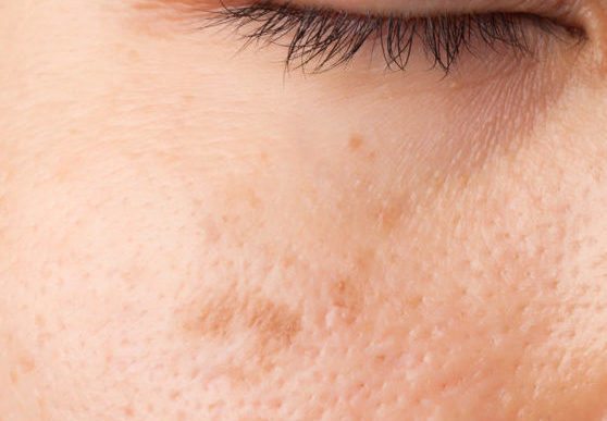 Difference Between Large Pores And Acne Scars – Re'equil