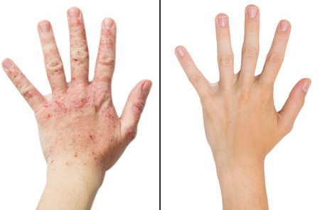 Eczema Treatments Available From Dermatologist Dr. Gergana Gallacher  Dermatology and Laser Centre