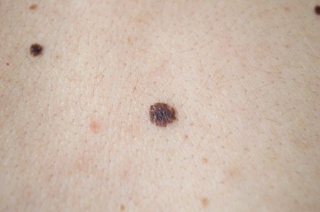 Recognize and Treat Melanoma - Dermatologist Dr. Gergana Gallacher ...