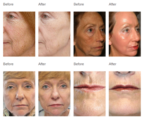 Fractional Co2 Laser The Gold Standard For Skin Rejuvenation