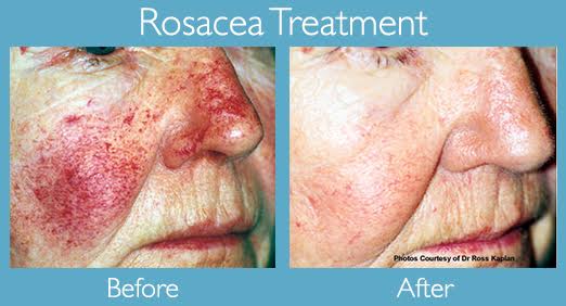 Great Treatment Options For The Signs And Symptoms Of Rosacea Dermatology And Laser Centre 