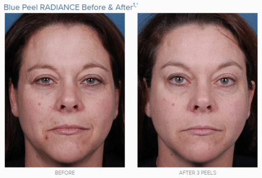 Chemical Peel Obagi_Blue_Peel_Radiance_Before-After_A